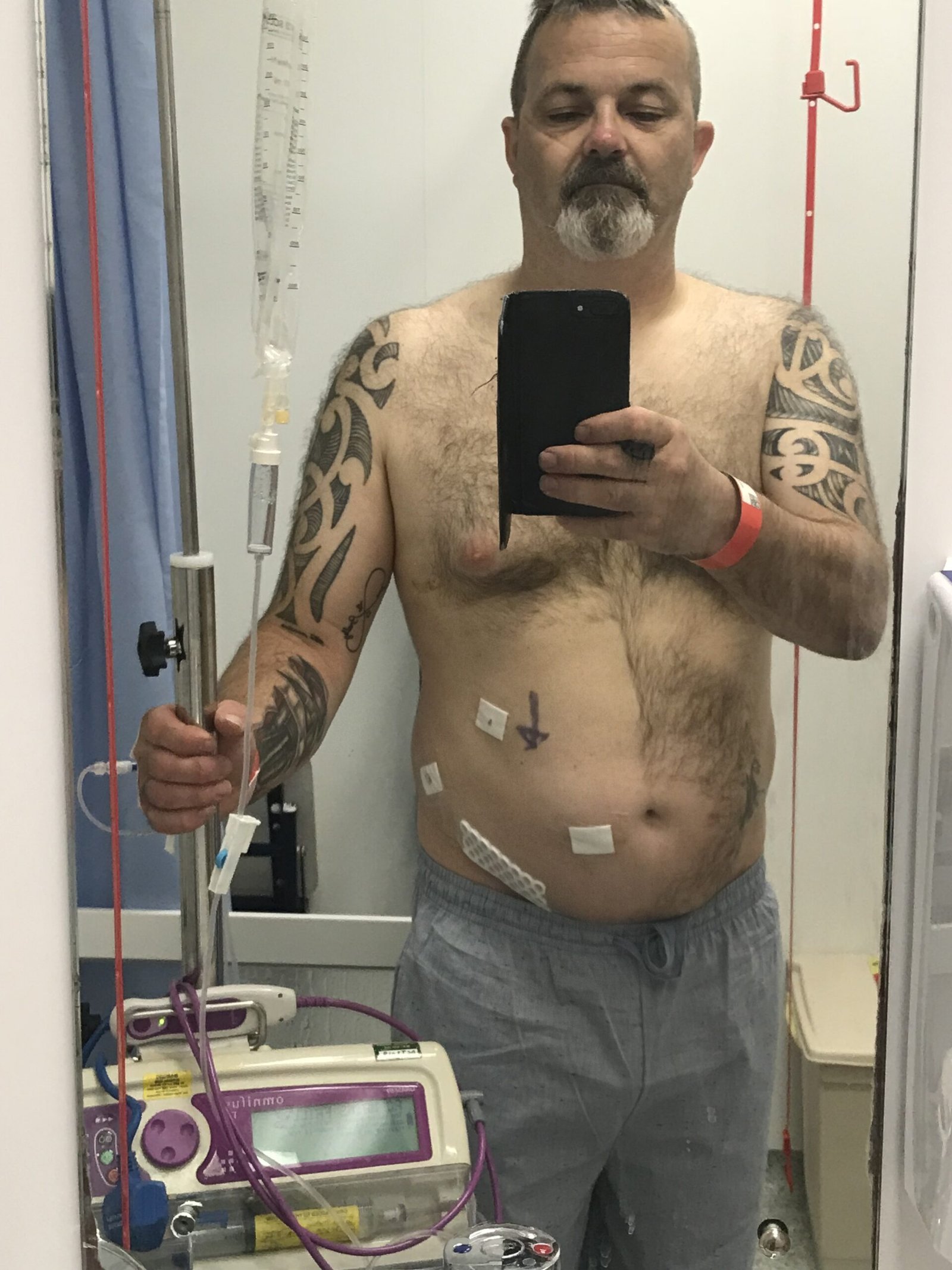 Non-directed living kidney donor David